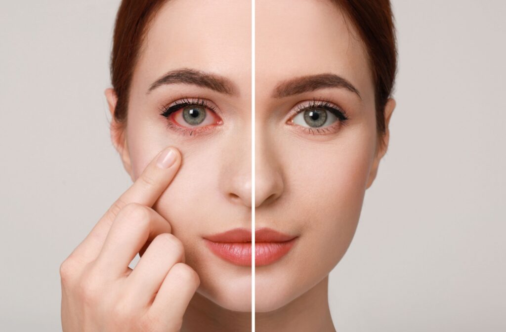 A side-by-side comparison of a person with pink eye and a healthy eye.