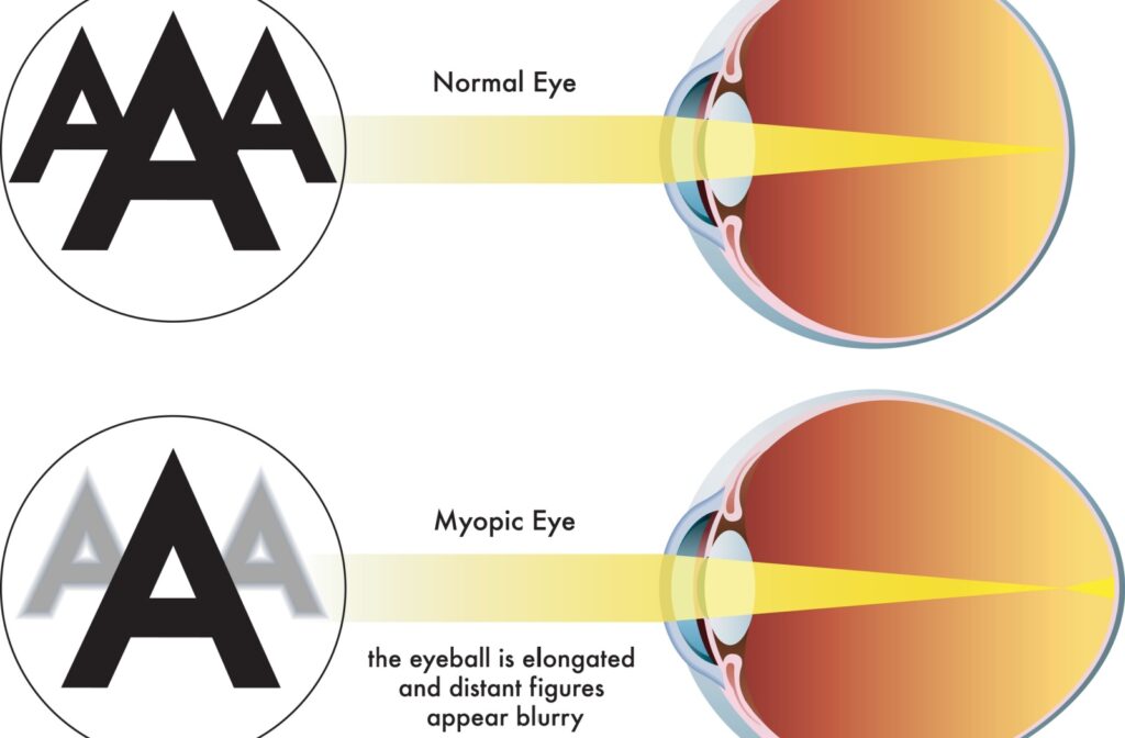A diagram of a normal eye vs. a myopic eye.